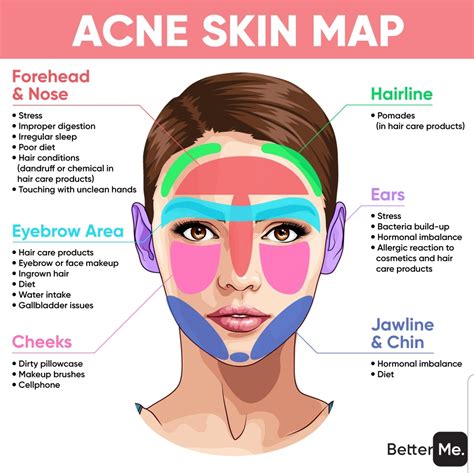 What Causes Acne Chart